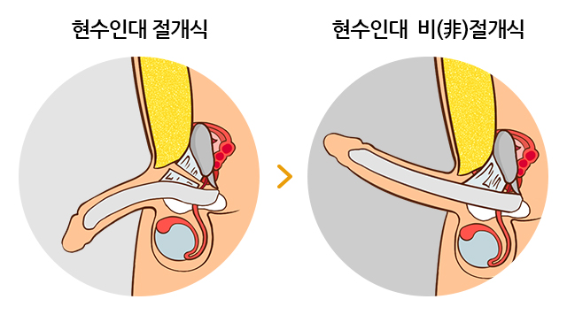 하이맨 자라고추교정 길이연장술