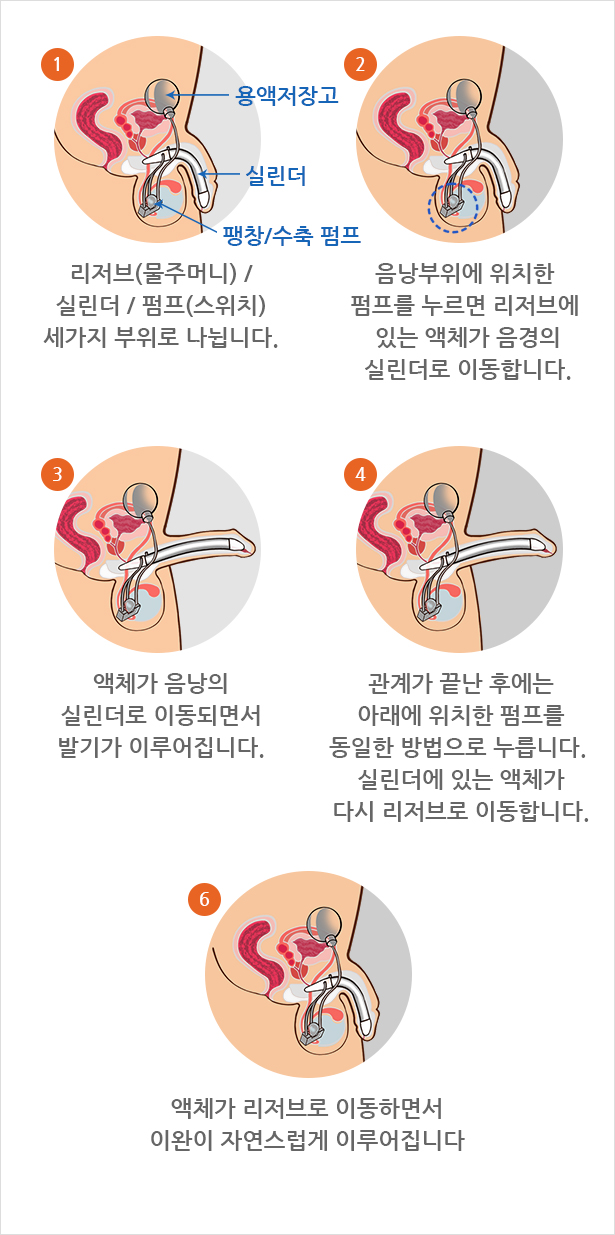 팽창형 인플란트 삽입술