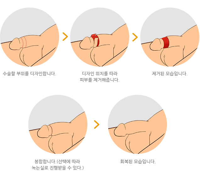 기존레이저포경수술